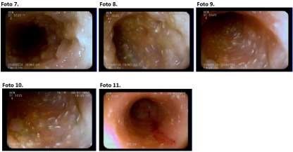 Imagens da mucosa intestinal à endoscopia alta, detalhe para as placas irregulares em formato de espículas