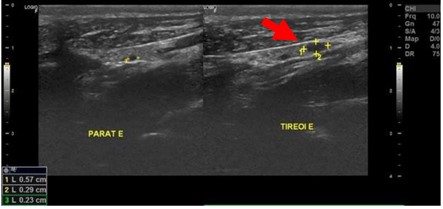 Ultrassonografia cervical evidenciando aumento de paratireoide caudal esquerda, medindo 0,57 cm em seu maior eixo (seta vermelha)