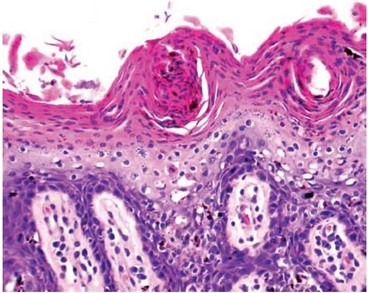 Síndrome Hepatocutânea. Coloração por hematoxilina e eosina. Lesões com característico padrão “vermelho, branco e azul”, que correspondem a uma camada de hiperceratose (vermelho), vacuolização/edema dos queratinócitos (branco) e hiperplasia da epiderme (azul). Fonte: SANTOS; ALESSI, 2016.